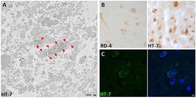 Altered Levels and Isoforms of Tau and Nuclear Membrane Invaginations in Huntington’s Disease